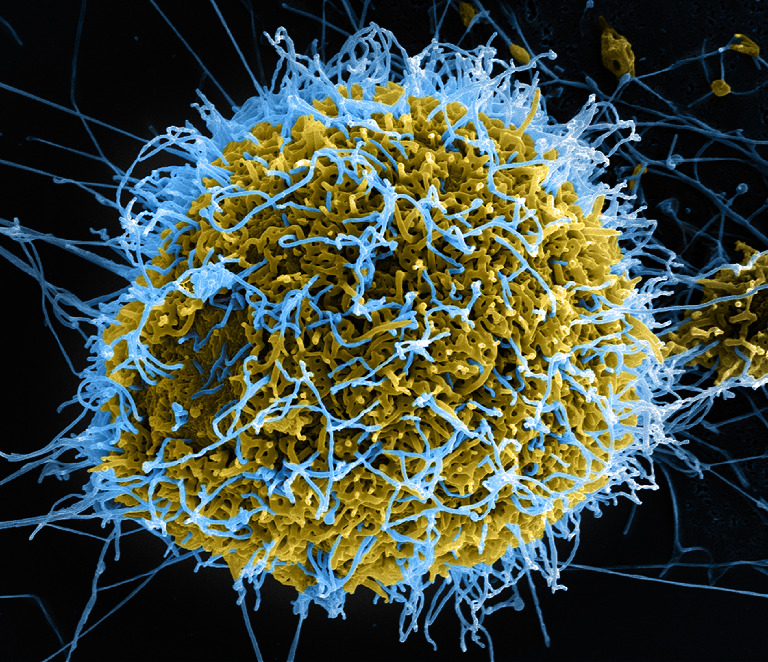 Resultado de imagen de citomegalovirus  IMAGENES